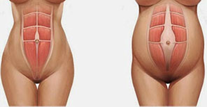 diastasis abdominal