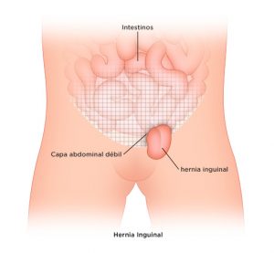hernia-abdominal-blog-iocir
