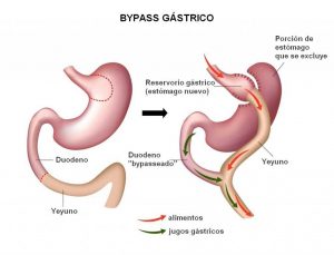 bypass-iocir