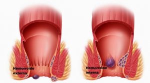 hemorroides-tipos-iocir