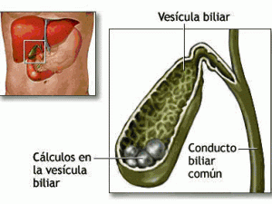 cirugia del higado-colelitiasis