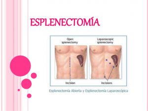 esplenectomia-bazo