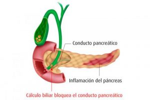 inflamación-páncreas