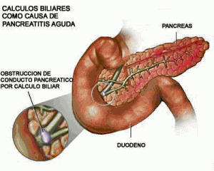 pancreatitis-aguda