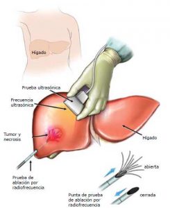 quistes-del-hígado-tratamiento-percutáneo