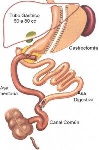 cirugia de la obesidad cruce duodenal