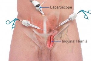 imagen-laparoscopia
