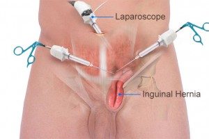 imagen-laparoscopia