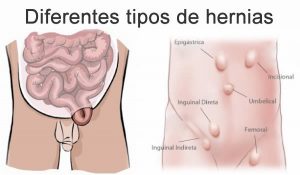 imagen-tipos-hernias