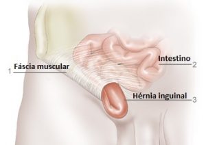 hernia inguinal banner