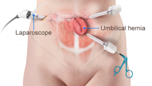 hernia umbilical laparoscopia