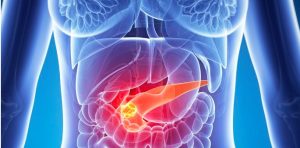 cancer de pancreas-IOCir.com/blog