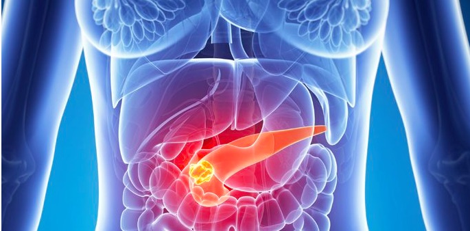 cancer de pancreas-IOCir.com/blog