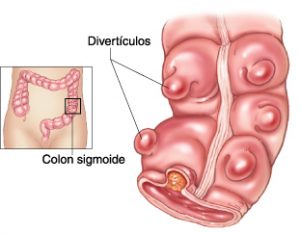 diverticulitis aguda y colon sigmoide