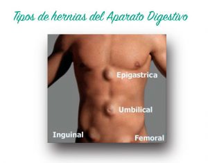 hernias : tipos y tratamientos