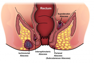 fistula-iocir.com/blog