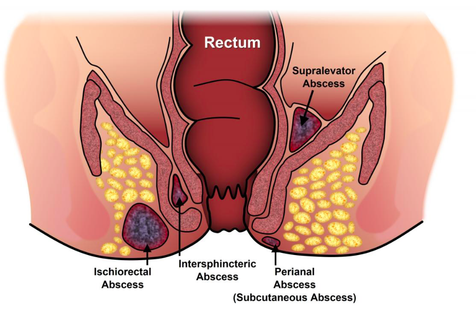 fistula-iocir.com/blog