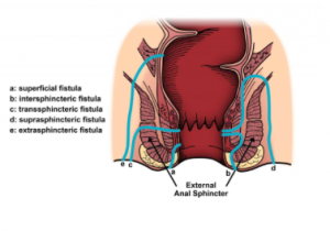 fistula-tipos-anal-iocir.com/blog