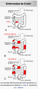 enfermedad de croan-cirujanos huelva-iocir.com/blog