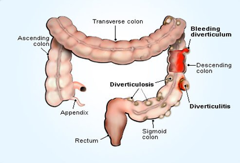 enfermedad diverticular-iocir.com/blog