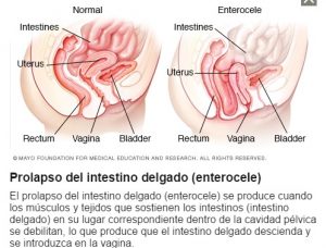 enterocele-iocir