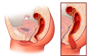 sindroma de ulcera rectal-iocir.com/blog