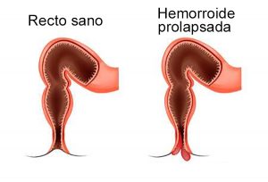 hemorroide prolapsada-sintomas de hemorroides-cirujanos en huelva-iocir