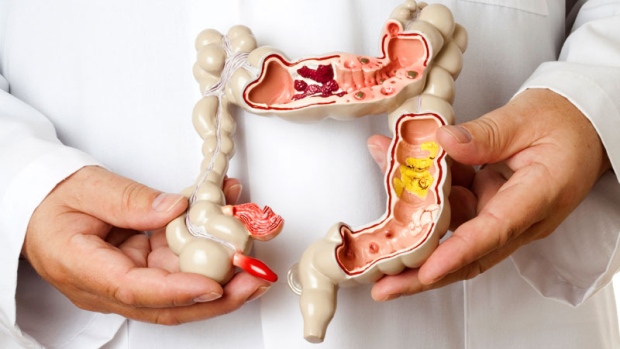 sindrome del intestino irritable, sindrome de colon irritable, colon espastico, colitis mucosa, iocir, cirujanos en huelva, medicos en huelva