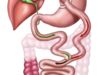 Bypass gástrico: Riesgos y beneficios