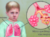 Fibrosis quística: diagnóstico, síntomas y tratamiento