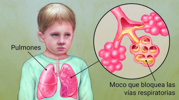 Fibrosis quística: diagnóstico, síntomas y tratamiento - IOCir